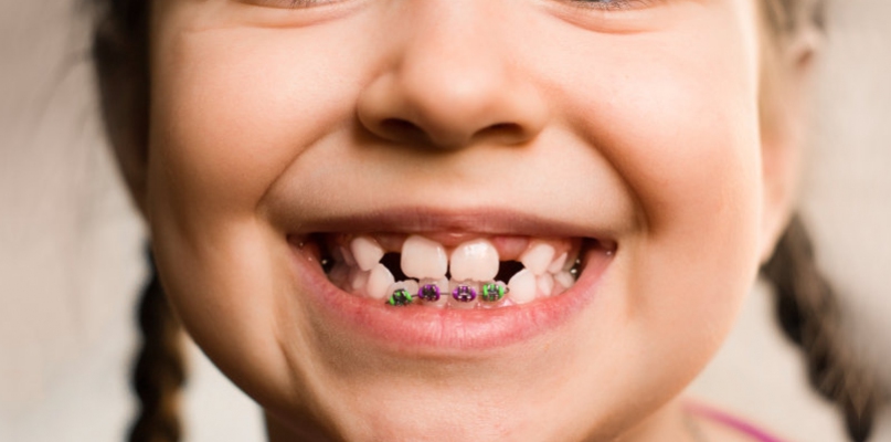 Gdzie do ortodonty? NFZ przyznał kontrakty dwóm poradniom