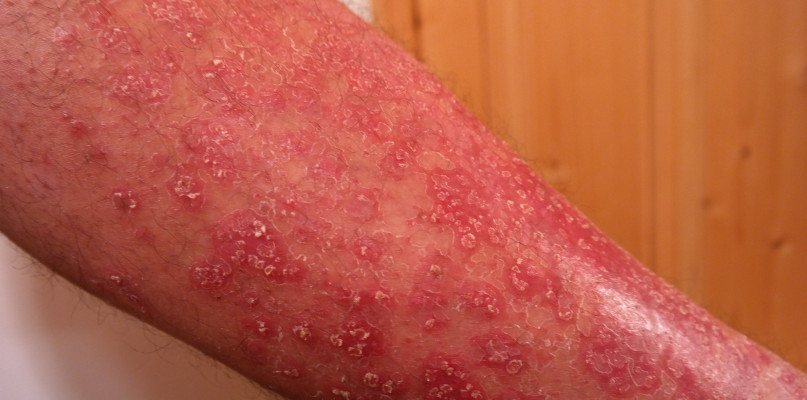 Czy łuszczyca jest zaraźliwa?