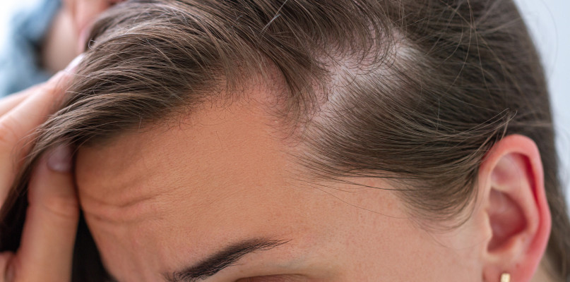 Przeszczep włosów u kobiet