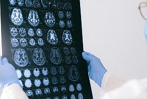 Codzienność opieki - życie bliskich z chorobą Alzheimera