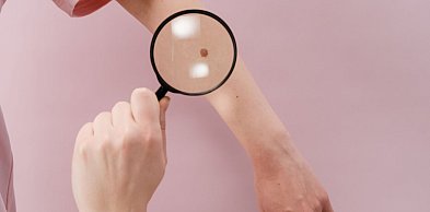Chroń skórę! 500 mieszkańców Łódzkiego z czerniakiem