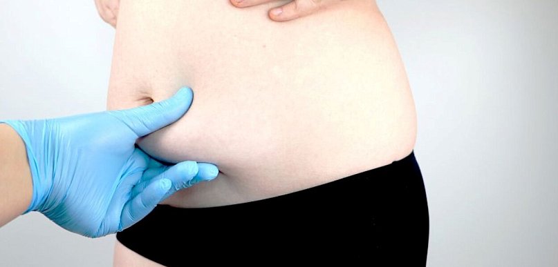 Jak przygotować się do zabiegu liposukcji?